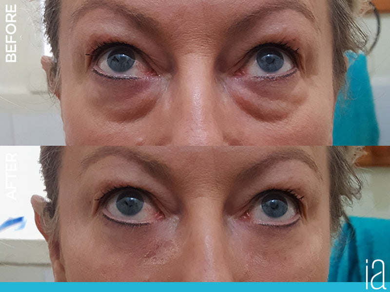 Facelift In A Box (Best Value! 25 Vials!)