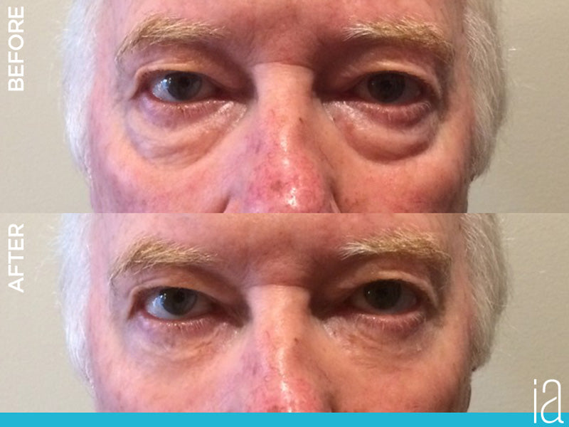 Facelift In A Box (Best Value! 25 Vials!)